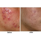 A.Spot Cream Set