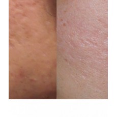 痘疤毛孔修復精華素 – 零毛孔