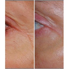 基因激活除皺霜套裝